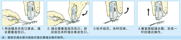 马尼皮肤缝合器-缝合器,吻合器